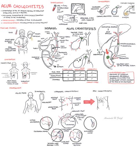 Acute Cholecystitis - Armando Hasudungan