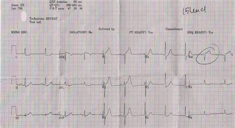 Dr. Smith's ECG Blog: Septal STEMI with ST elevation in V1 and V4R, and reciprocal ST depression ...