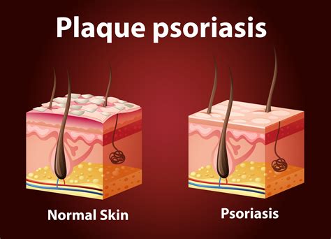 Schéma montrant le psoriasis en plaques - Telecharger Vectoriel Gratuit, Clipart Graphique ...