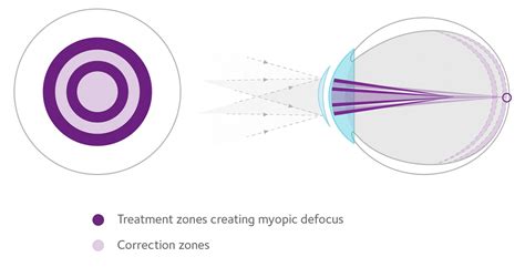 Mastering MiSight 1 day - Myopia Profile