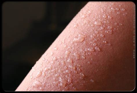 What Are The Symptoms Of Sunburn?