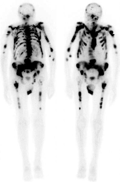 17 superscan (Prostate Cancer) | Radiology Key