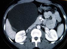 Liver Cyst | Surgery Photos