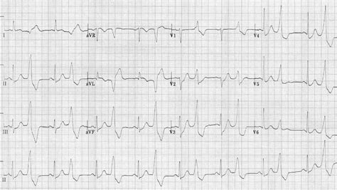 Premature Ventricular Complex