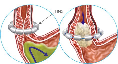 LINX - Cheyenne Regional Medical Center