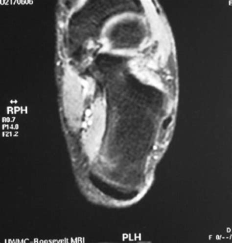 Stress fracture MRI - wikidoc