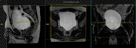 Urinary bladder MRI Protocols and Planning | Indications for MRI Urinary Bladder