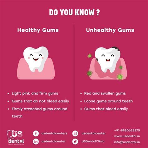 "Do you know? What are the symptoms of Healthy Gums and Unhealthy Gums? | Dental fun facts ...