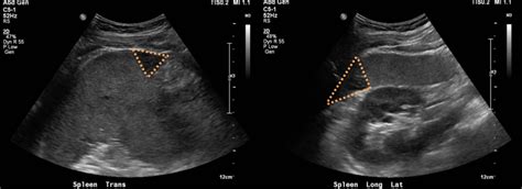 emDOCs.net – Emergency Medicine EducationSplenic Infarction in Mononucleosis: Pearls and ...