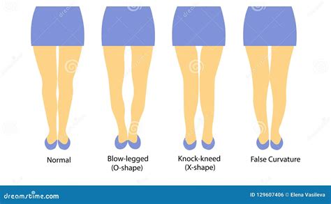 Shapes Of The Legs. Normal And Curved Legs. Knock Knees. Bowed Leg Cartoon Vector ...