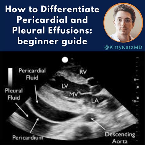 Pericardial and Pleural Effusions on US | Marc Katz MD