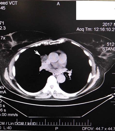 Cureus | Mediastinal Cartilaginous Hamartoma