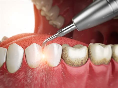 Scaling & Root Planing (Deep Cleaning) • Carson Periodontics And Oral & Maxillofacial Surgery