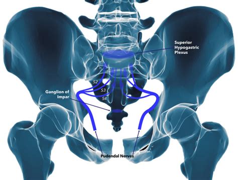 Pudendal Nerve Ablation Procedure - mapasgmaes