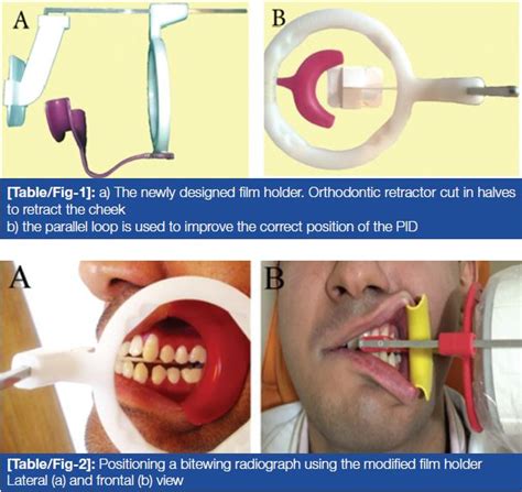 Utility of a Newly Designed Film Holder for Premolar Bitewing ...