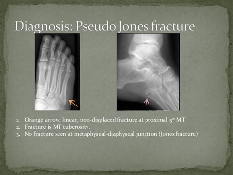 Pseudo Jones Fracture