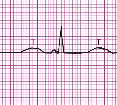 EKG STRIP RHYTHMS Flashcards | Quizlet