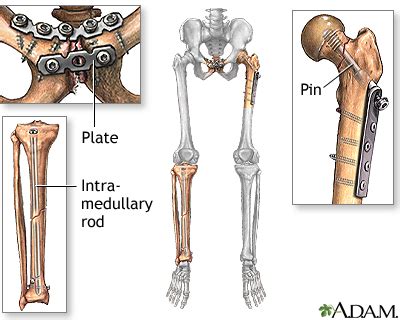 Bone fracture repair - series—Procedure: MedlinePlus Medical Encyclopedia