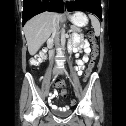 Normal CT abdomen | Image | Radiopaedia.org