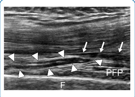 Figure 1 from Functional status of the articularis genus muscle in ...