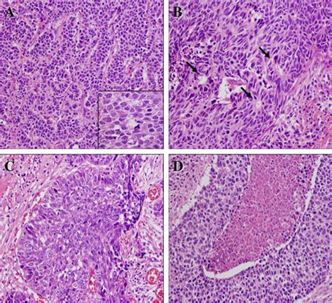 Histological findings of mucosal large cell neuroendocrine carcinoma ...