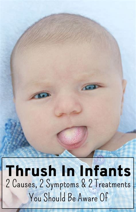 Thrush Baby Tongue Symptoms