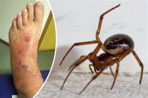 False widow spider bite left dad in hospital with viral meningitis | Daily Star