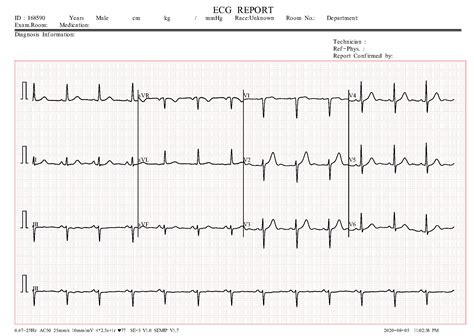 ECG Signal Classification Classification Dataset and Pre-Trained Model by Muhammad Faizan