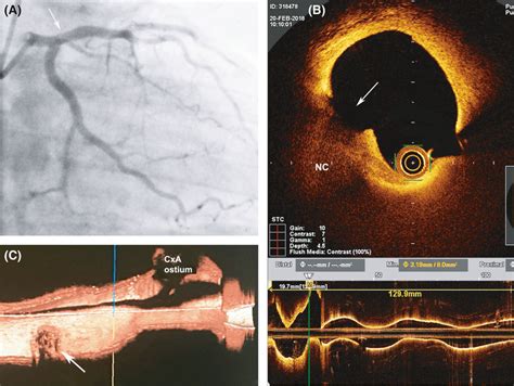 Angiography and OCT immediately after Interventional procedure: (A ...