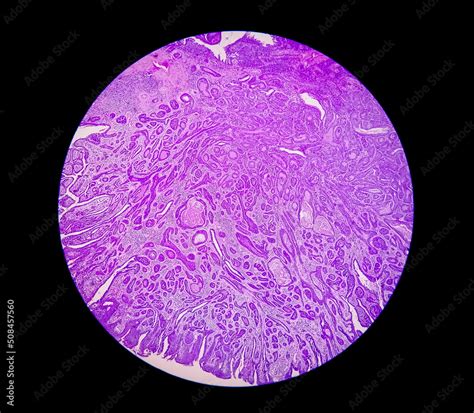 Histological slide under microscopy showing Pedunculated squamous ...