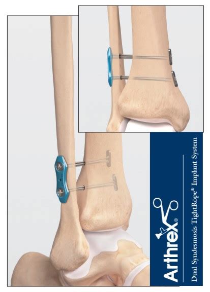 Ankle Syndesmosis Repair: The Evolution of a Protocol Part I