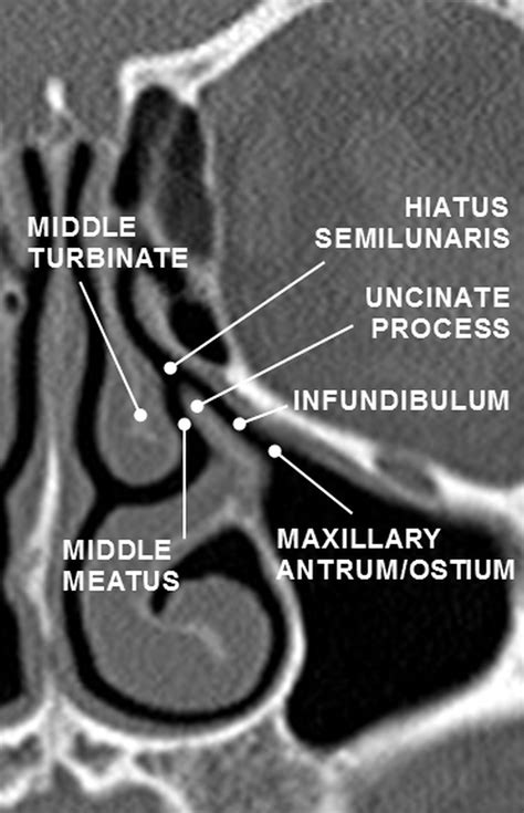 The Preoperative Sinus CT: Avoiding a “CLOSE” Call with Surgical ...