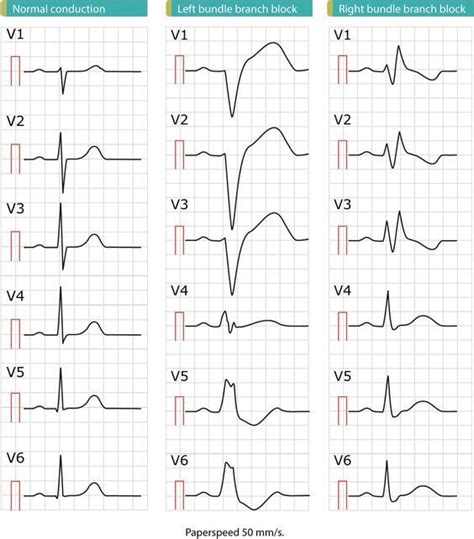 Learn about left bundle branch block (LBBB), with emphasis on ECG ...