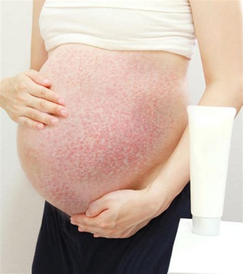 PUPPP Rash: Causes, Symptoms And Treatment