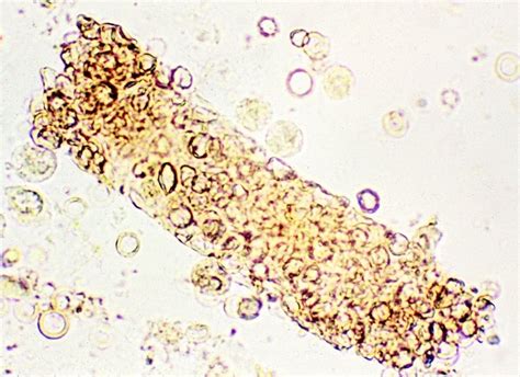 Red Blood Cells Casts in Renal Hematuria | Medical Laboratories