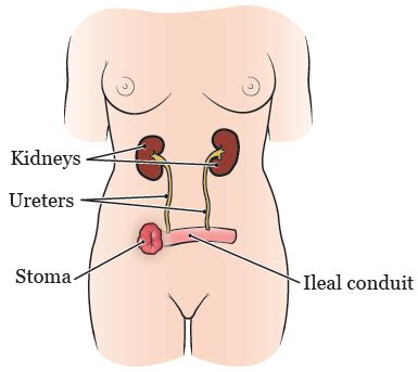 A Quick Guide To Urostomy Basics United Ostomy Associations, 51% OFF