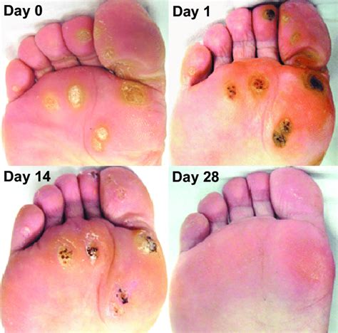 Infected Plantar Wart