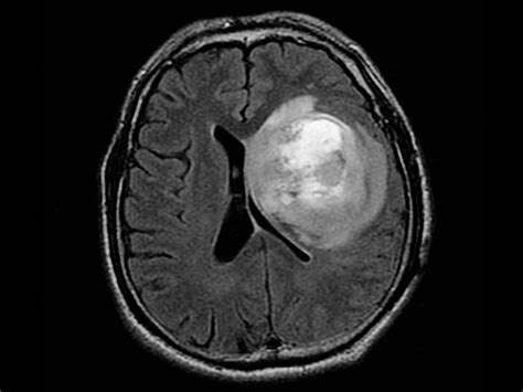 Glioblastoma: Glioblastoma Drugs