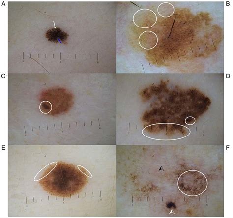 'Chaos and clues' in atypical nevi and melanoma. (A) Atypical nevus ...