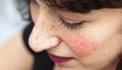 Blotchy Skin or Rosacea – What’s the Difference? | 100% PURE