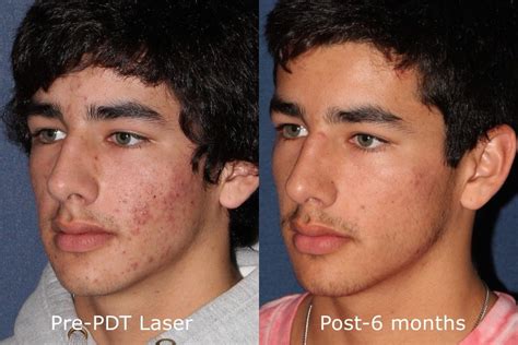 Photodynamic Therapy Acne Treatment | San Diego, CA | CLDerm