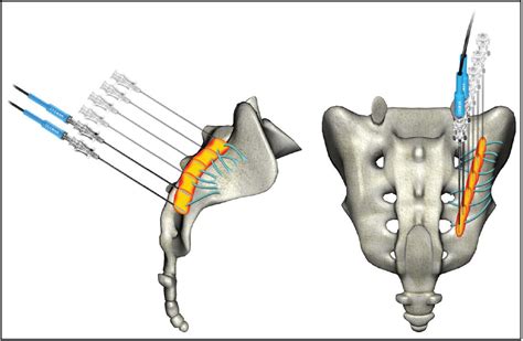 Si Joint Dysfunction - Pain Relief | Aptiva Health