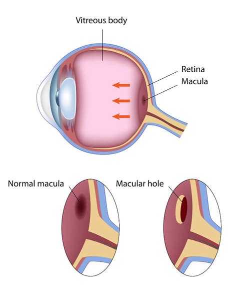 National Retina Institute | Macular Holes | Maryland