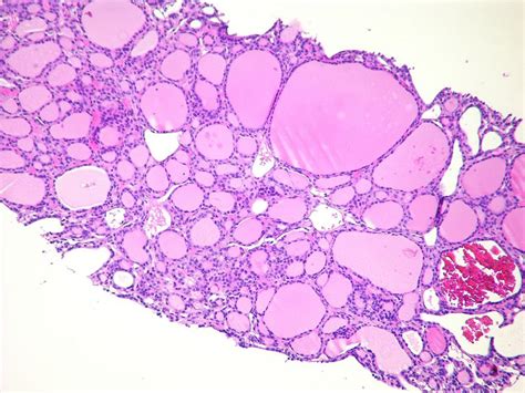 Follicular thyroid cancer diagnostic study of choice - wikidoc