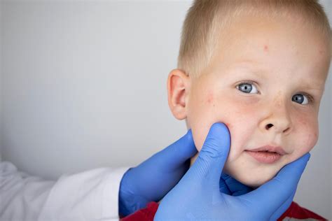 Florida Surgeon General Defies CDC Guidance Amid School Measles Outbreak | The Medicine Shoppe ...