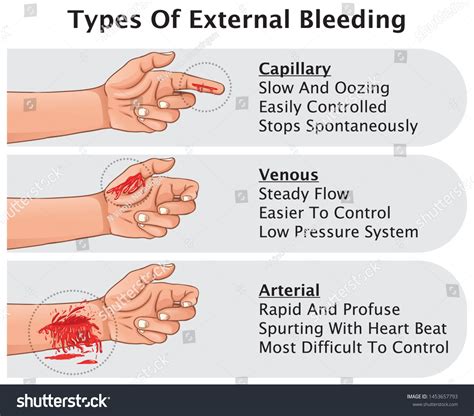 4,226 imágenes de Arterial bleeding - Imágenes, fotos y vectores de ...