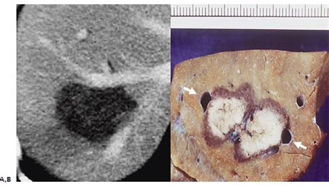 5 Liver Ablation | Radiology Key