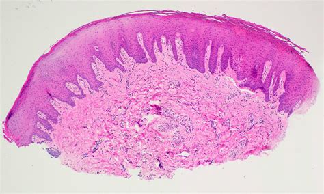 Inflammatory Papillary Hyperplasia Histology