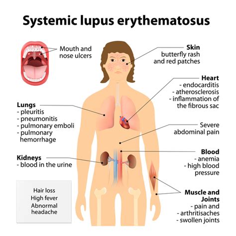 Systemic lupus erythematosus: MedlinePlus Genetics