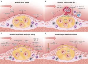 Atherosclerotic Plaque Healing | NEJM